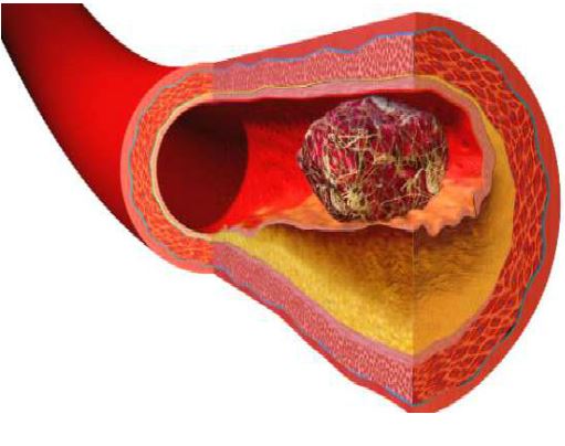 Kako spriječiti formiranje krvnog ugruška (tromba)